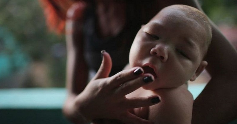 জিকা ভাইরাসে আক্রান্ত হলে শিশুরা অস্বাভাবিক রকমের ছোট মাথা নিয়ে জন্মগ্রহণ করে।